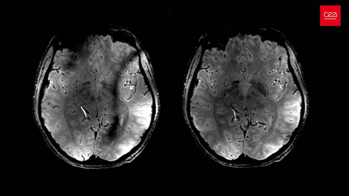 com-ia,-cientistas-conseguem-prever-envelhecimento-cerebral
